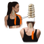 Referred Pain - Spine